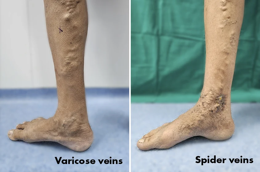 What is the Difference Between Spider Veins and Varicose Veins? The Ultimate Guide