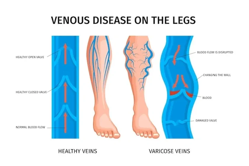 What Happens If a Varicose Vein Bursts? All You Need to Know