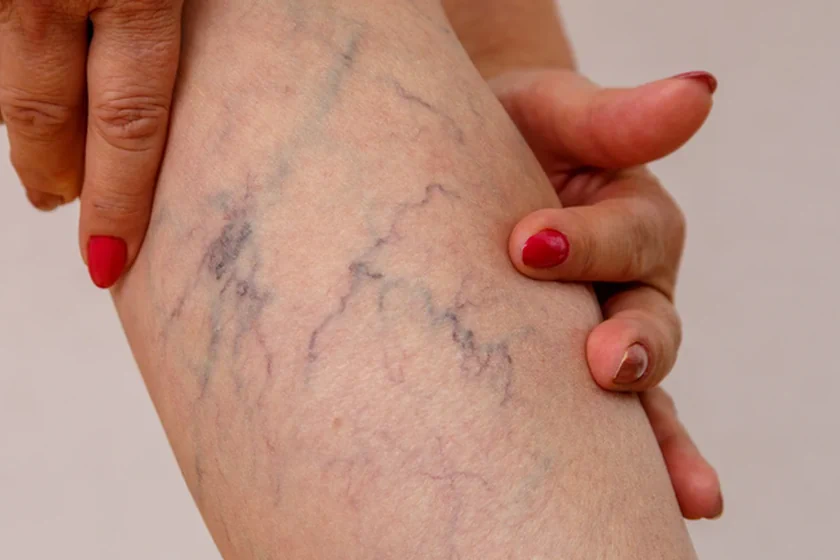 Unveiling the Mystery: Why Are My Veins So Visible All of a Sudden?