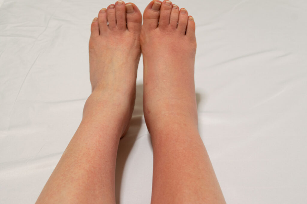 A leg with the symptom of bacterial cellulitis