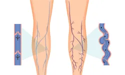Varicose-Vein01