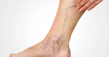 Varicose Veins