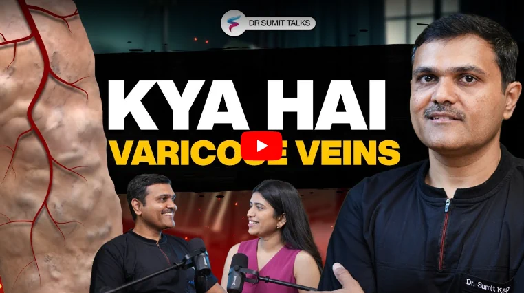 varicose veins