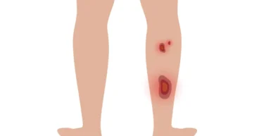 leg ulcer treatment