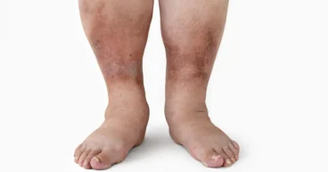 swelling leg