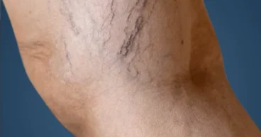 spider veins