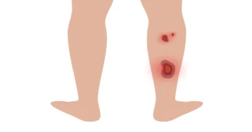 venous ulcers vs arterial