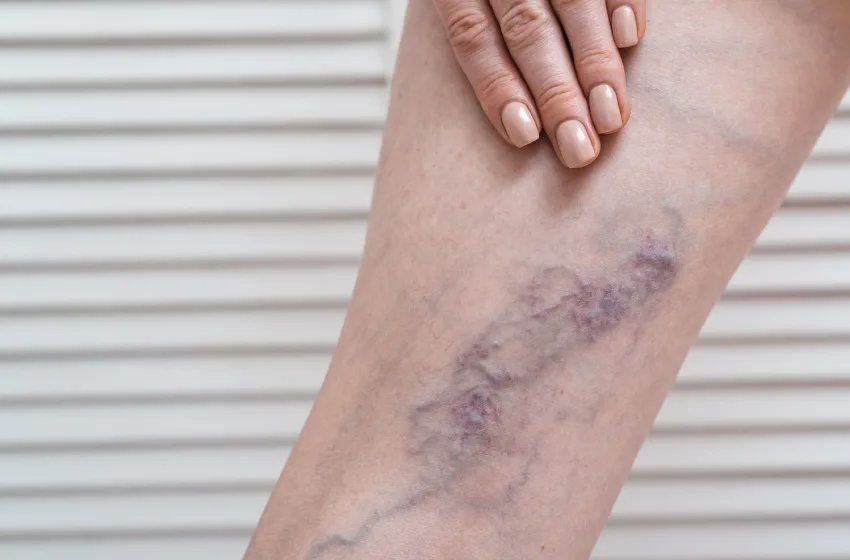 Varicose Veins & Cancer: Understanding the Symptoms & Risks