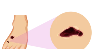 toe ulcers treatment