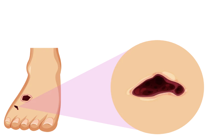 toe ulcers treatment