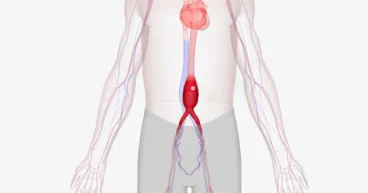 Endovascular Aneurysm Repair