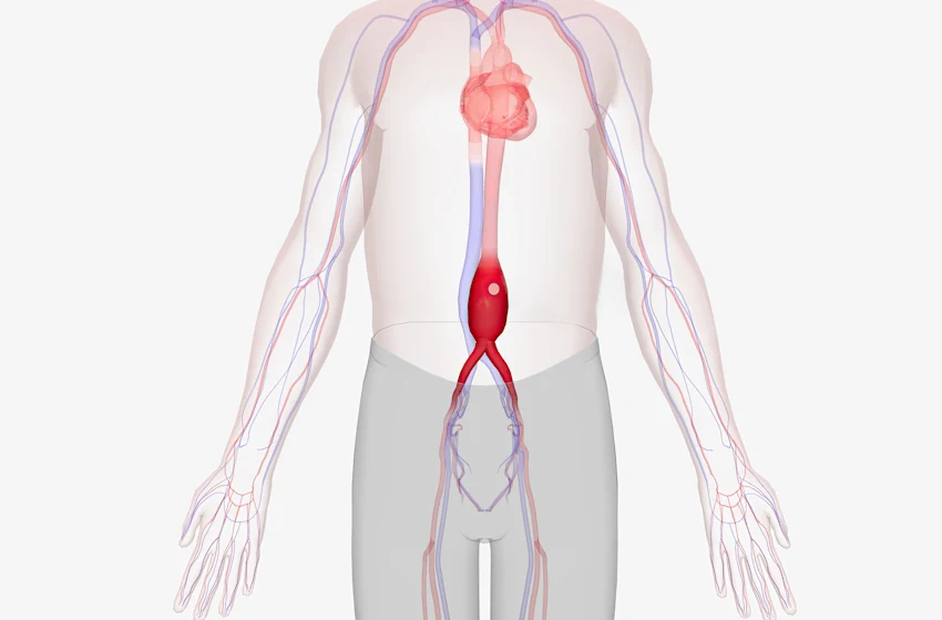 How Long Does Recovery Take After Endovascular Aneurysm Repair?