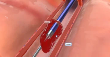 how to unclog arteries