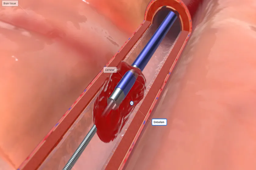 Unclog Arteries