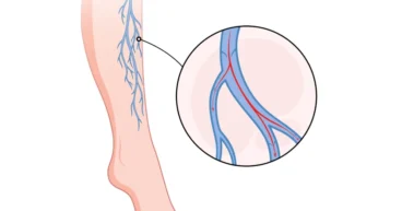 Peripheral Vascular Disease
