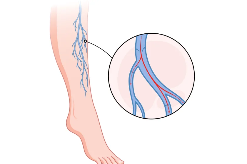 Peripheral Vascular Disease