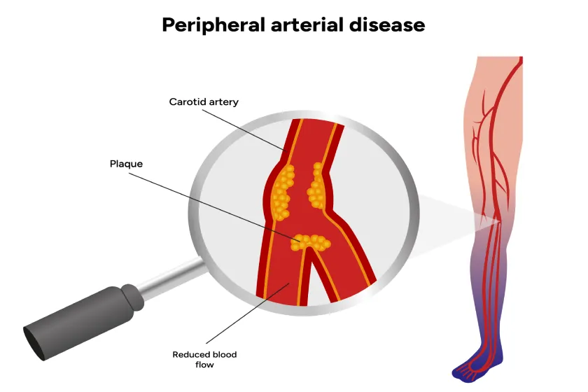 Walking Pain and Leg Cramps? It Might Be PAD