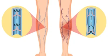 Varicose veins problem