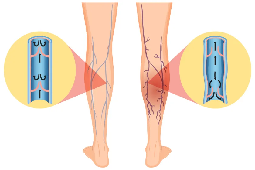 Varicose veins problem