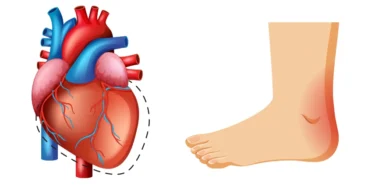 varicose veins problem