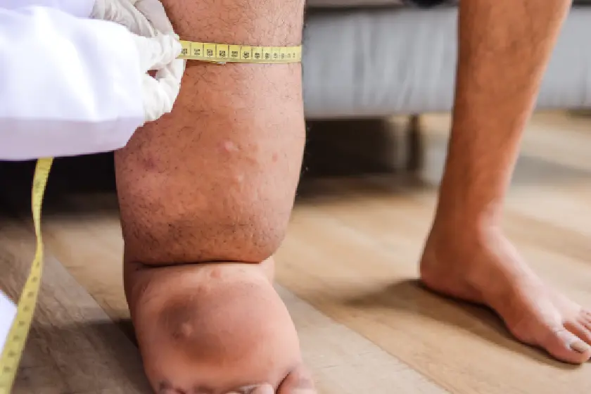swelling vs oedema