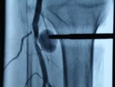 Popliteal pseudoaneurysm Popliteal pseudoaneurysm