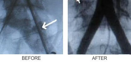 Vascular trauma before and after image