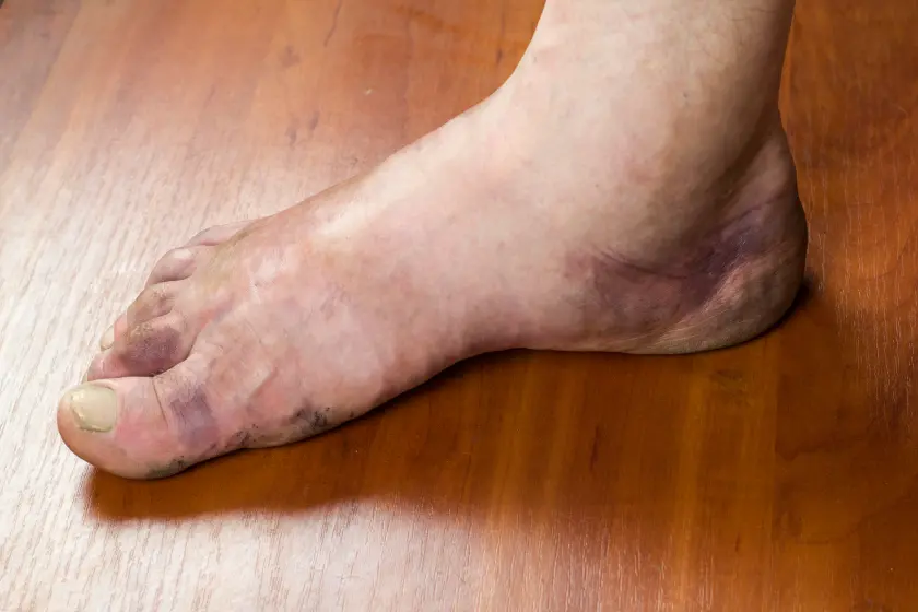 vascular problems in feet
