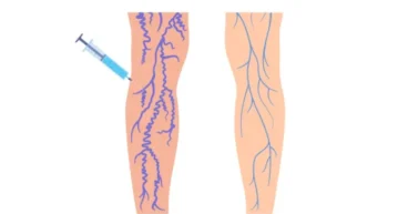 varicose vein treatment
