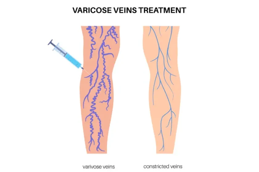 Best Time of Year to Treat Varicose Veins: What Doctors Recommend