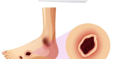 leg ulcer