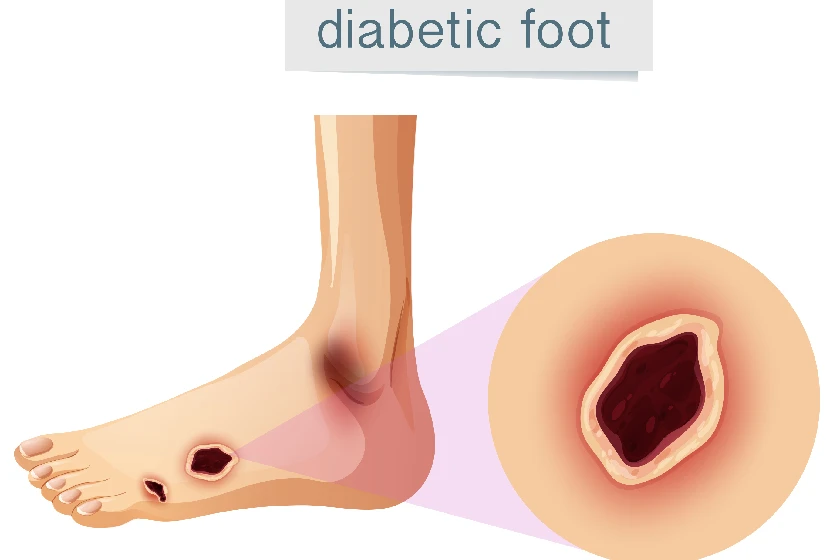 Stages of Leg Ulcer Healing: What to Expect