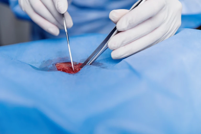 What to Expect Before, During, and After Endovascular Surgery