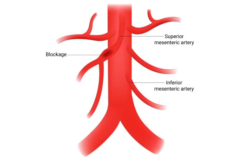 Early Warning Signs of Portal Mesenteric Vascular Diseases