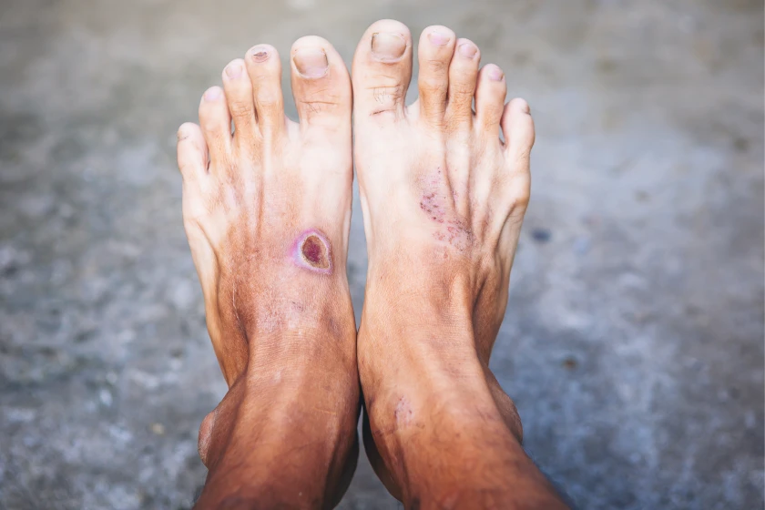 Signs Your Leg Ulcer Needs Urgent Medical Attention