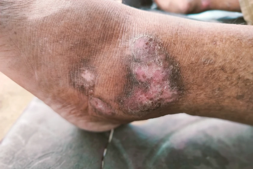 Common Myths About Leg Ulcers You Should Stop Believing