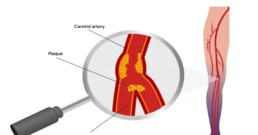 Signs of Peripheral Artery Disease (PAD)