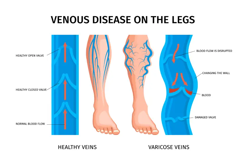 How Inflammation Is Linked to Varicose Veins?