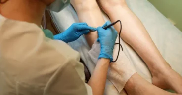 Laser Varicose Vein Treatment