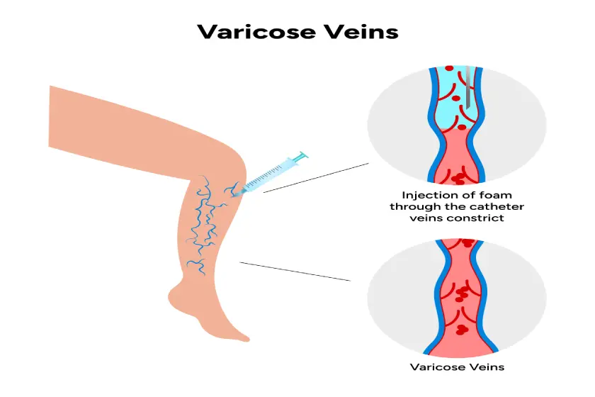 Mild vs Advanced Varicose Veins: Is Laser Treatment Effective for Both?