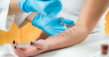 Laser Treatment for Spider Veins