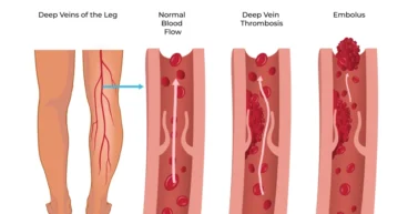 deep vein thrombosis treatment