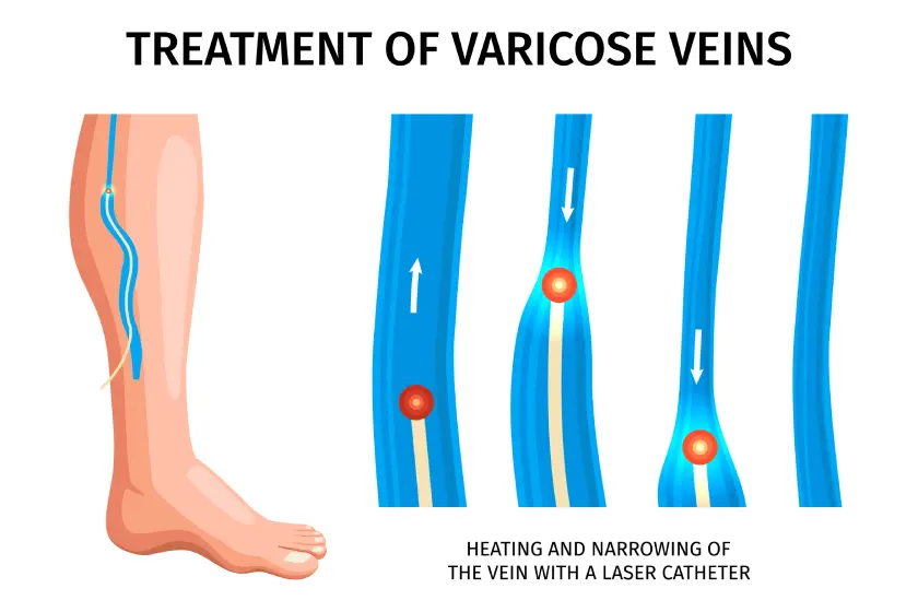 treatment for varicose veins