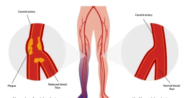 peripheral arterial disease treatment