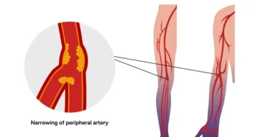 Blocked Leg Arteries Treatments