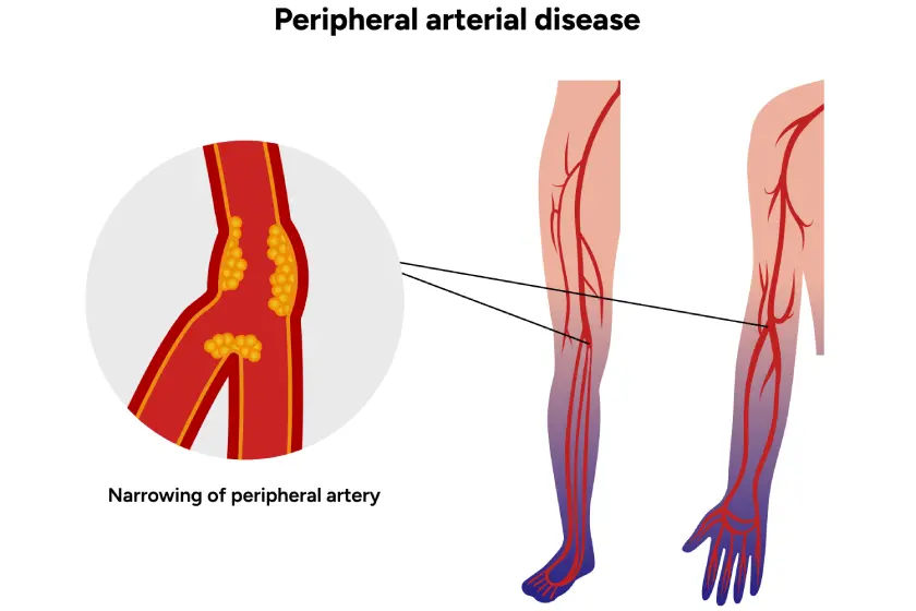 Blocked Leg Arteries Treatments