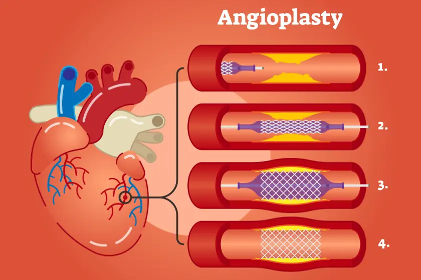 Leg Bypass Surgery vs Angioplasty Treatment for Blocked Leg Arteries