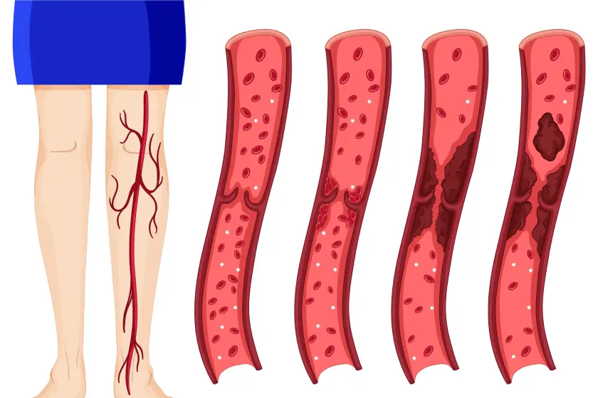 endovascular treatment