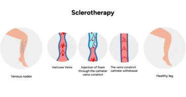 treatment for spider veins