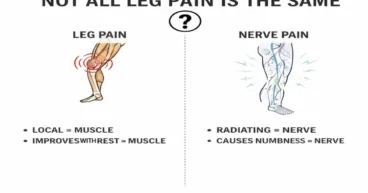 Leg Pain vs. Nerve Pain